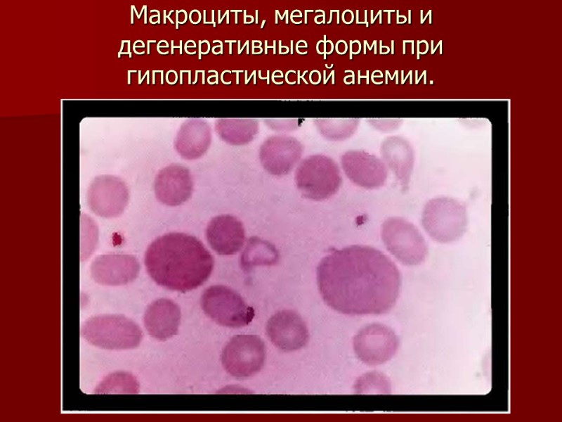 Макроциты, мегалоциты и дегенеративные формы при гипопластической анемии.